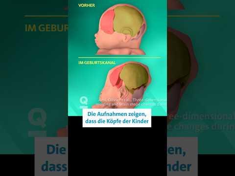 So stark werden die Schädel von Babys bei der Geburt verformt 🤯 | Quarks Dimension Ralph