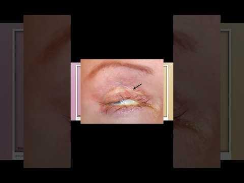 Augen NICHT schließbar nach Augenlidstraffung?! #beautyop #augenlidstraffung