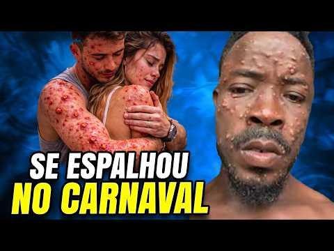 GRAVE DOENÇA SE ESPALHA NO CARNAVAL - EXPLOSÃO DE CASOS MPOX NO BRASIL