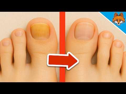 Nagelpilz entfernen💥(Schnell & Einfach)🤯