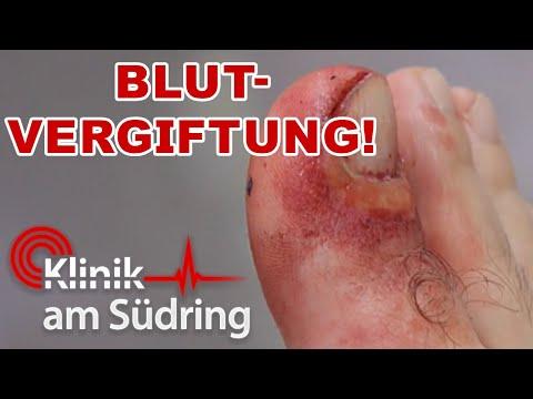 Unterschätzte Gefahr: Blutvergiftung durch entzündeten Zehennagel! | Klinik am Südring | SAT.1
